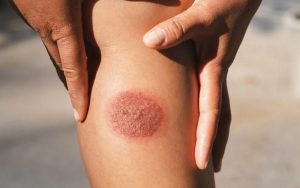 Kaki Kena Knalpot Memang Tidak Mengenakan, Berikut Tips Mengobatinya