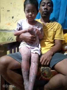 Elika Hasanah (6) Tahun di Vonis Iktiosis, Berharap Ada Yang Bisa Membantunya