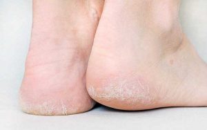 Tumit Pecah-Pecah Memang Bikin Ga Pede, Berikut Ini Tips Untuk Menghilangkannya