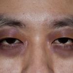 cara mengatasi mata panda