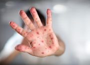 Kasus Positif Campak di Jabar Melonjak, Warga Diminta Waspada Saat Mudik