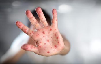 Ilustrasi kasus positif campak