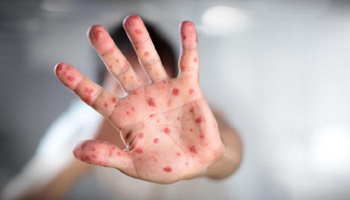 Kasus Campak Meningkat di Jabar, Dinkes: Jangan Anggap Remeh!