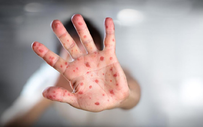 Ilustrasi kasus positif campak